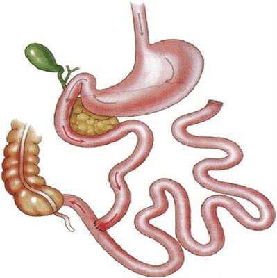Case report: Case series featuring anastomotic colonic adenocarcinoma following jejunoileal bypass requiring oncologic resection and jejunoileal bypass reversal
